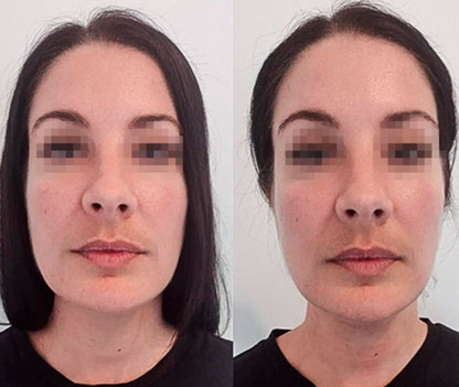 Slimélia® : Cure Détox Drainante 100% Naturelle